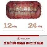 cam vit nieng rang bao lau thi thao