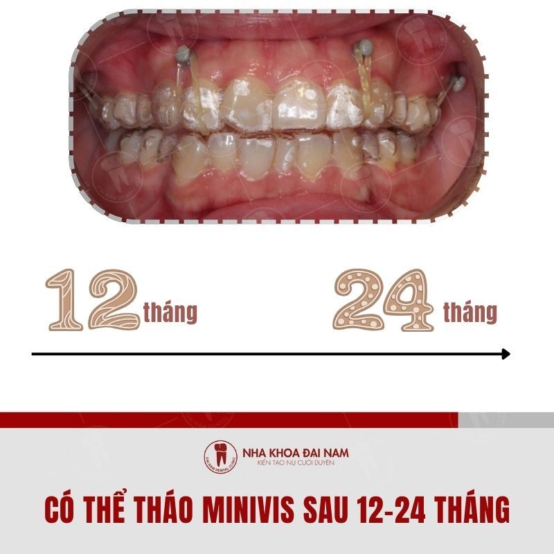 Co the thao minivis sau 12 24 thang