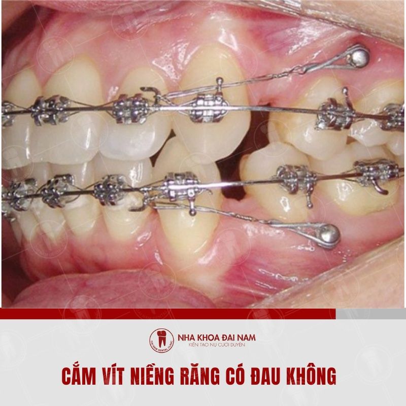 Bac si se gay te toan bo vung nuou giup ban khong con cam giac dau