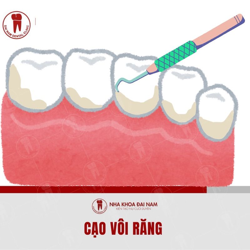 Voi rang chinh la o viem cua vi khuan