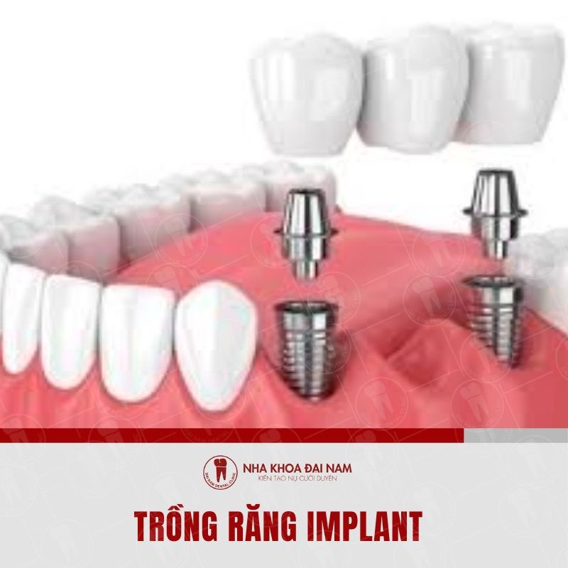 Trong rang implant la ky thuat cay ghep tru implant thay the chan rang