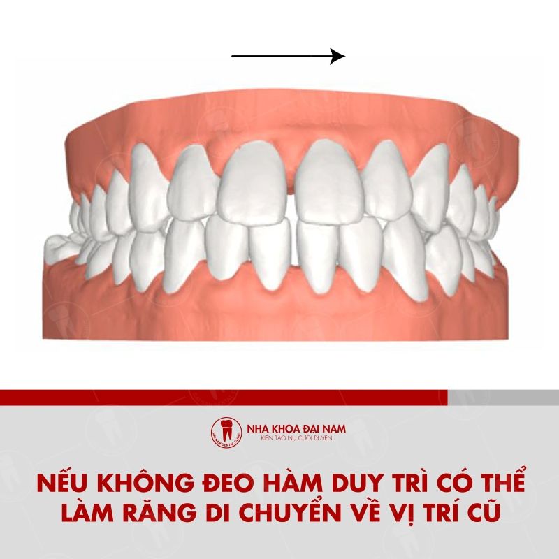 Thoi gian deo ham duy tri thuong keo dai tu 6–12 thang