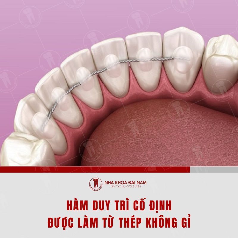 Ham duy tri co dinh duoc gan vao mat trong cua rang sau khi thao nieng