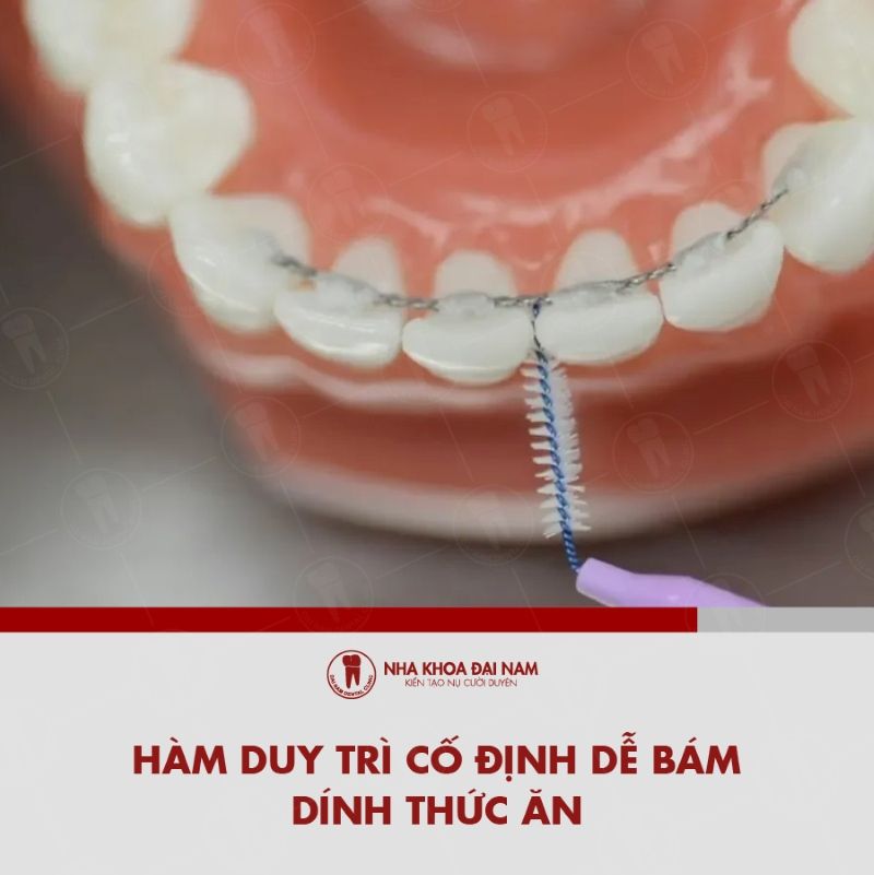 Ham duy tri co dinh de bam dinh thuc an vao rang
