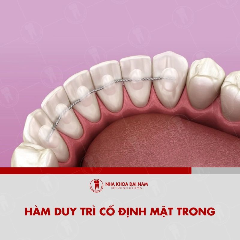 Ham duy tri co dinh mat trong duoc gan truc tiep o mat trong cua rang