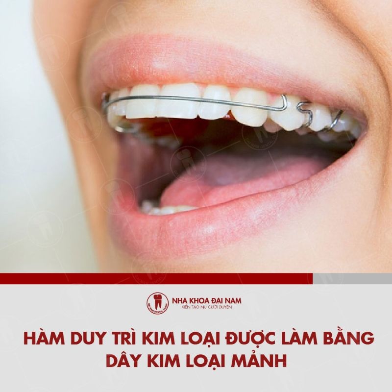 Ham duy tri kim loai la khi cu quan trong giup giu cho rang on dinh tai vi tri moi