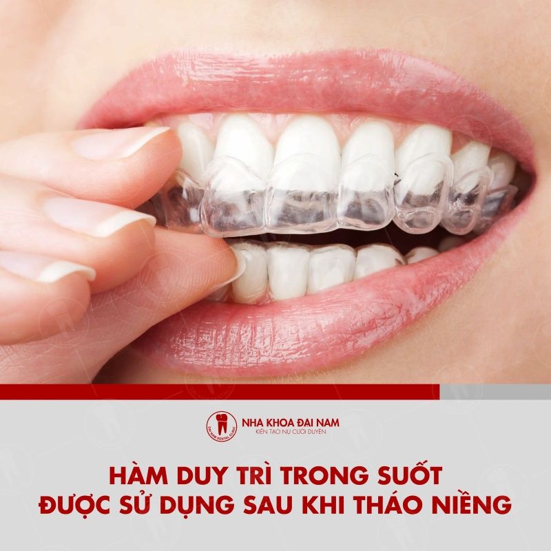 Ham duy tri trong suot la khi cu chinh nha duoc dung sau khi thao nieng