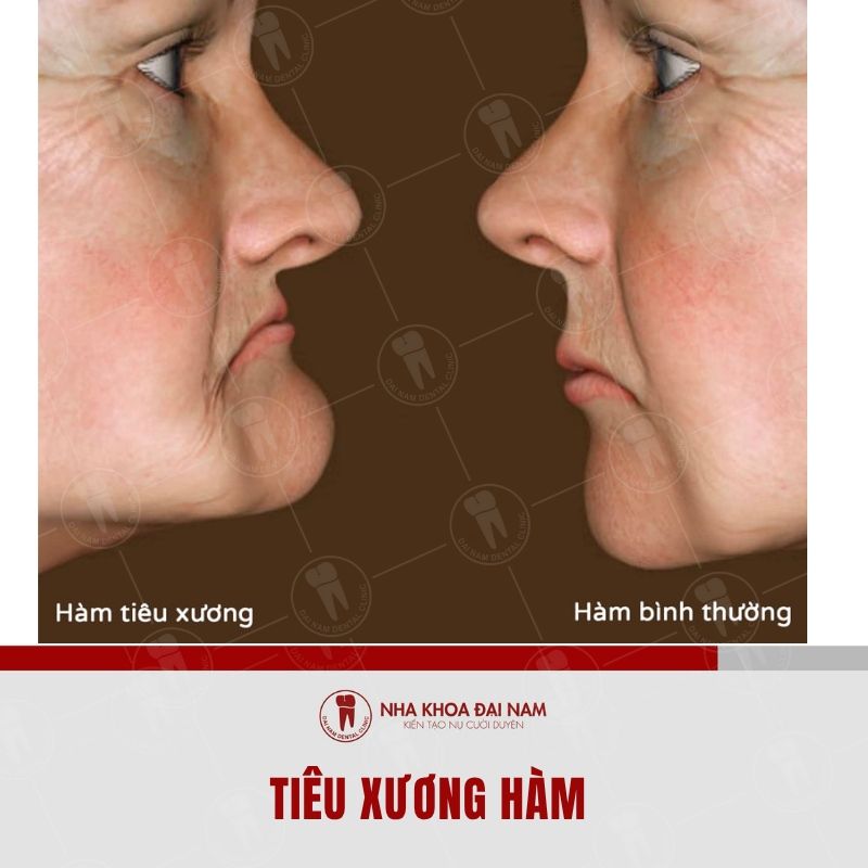 Mat rang so 6 lau nam se lam xuong ham tieu bien theo thoi gian