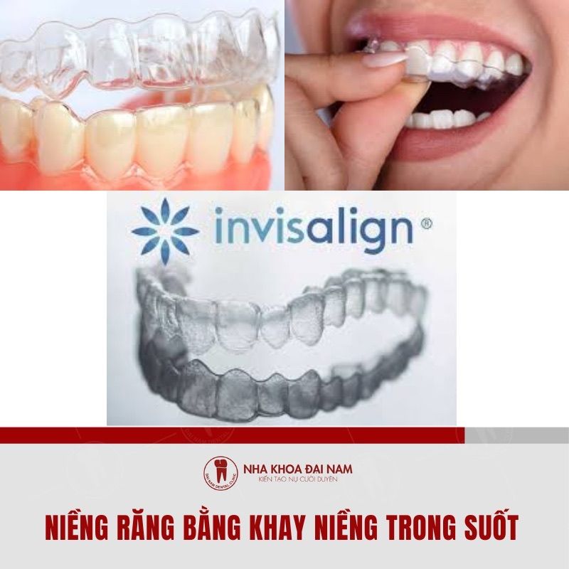 									 Nieng Invisalign tai Nha Khoa Dai Nam