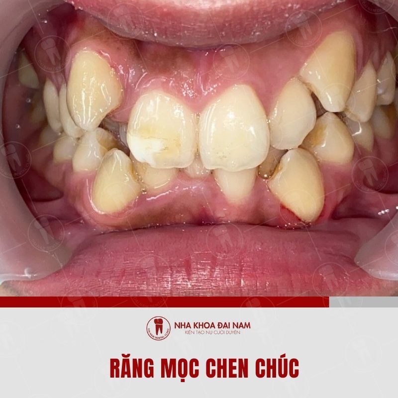Nong ham khi rang moc chen chuc khong du khoang de rang dich chuyen