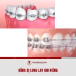 Rang lung lay khi nieng