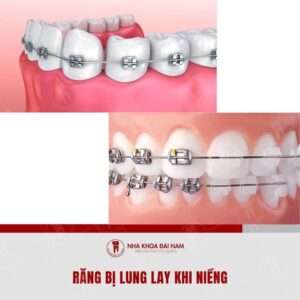 Rang lung lay khi nieng