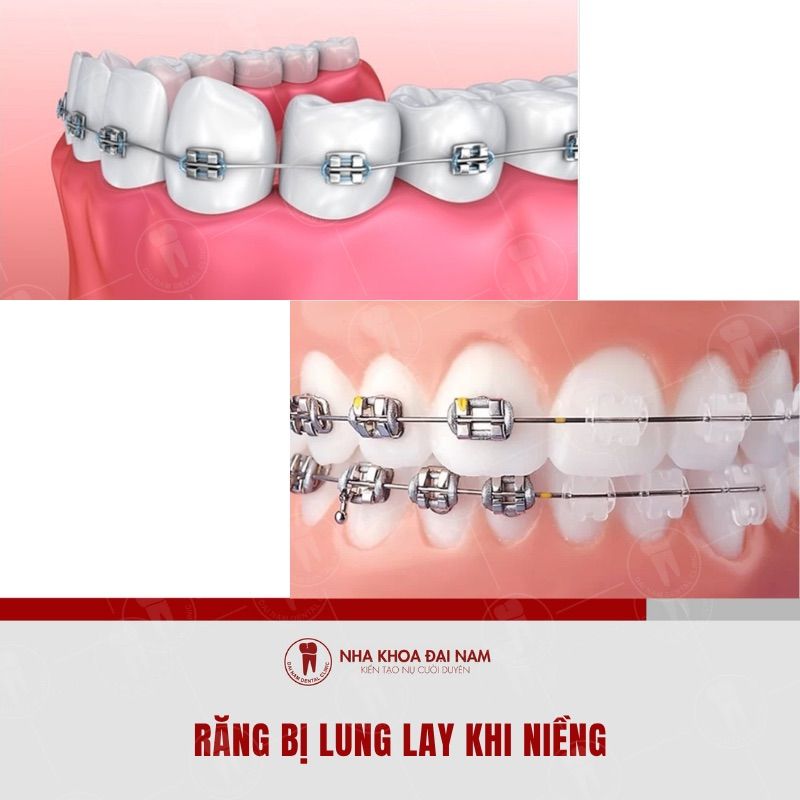 Rang lung lay khi nieng