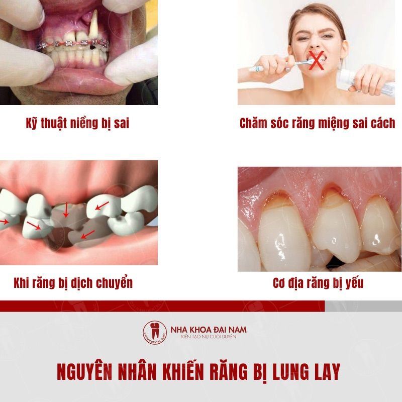  Nhung nguyen nhan pho bien khien rang bi lung lay