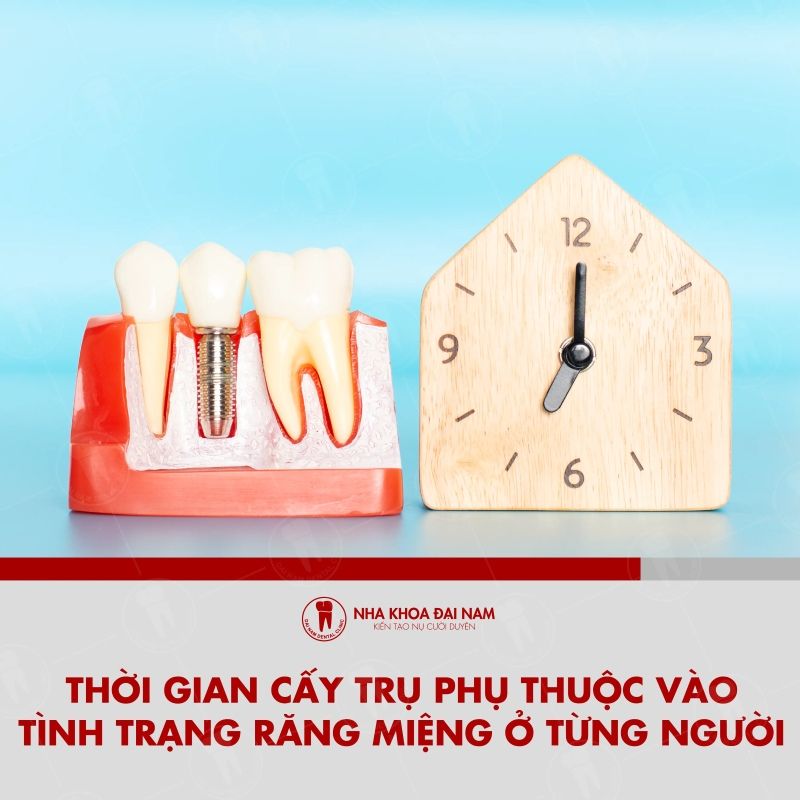 Thoi gian cay tru Implant Kontact phu thuoc vao tinh trang rang mieng cua tung nguoi