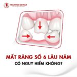 mat rang so 6 lau nam