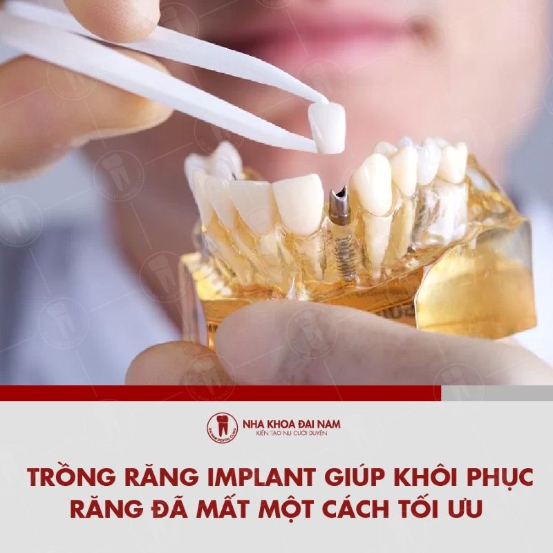Trong rang Implant giup khoi phuc rang da mat mot cach toi uu