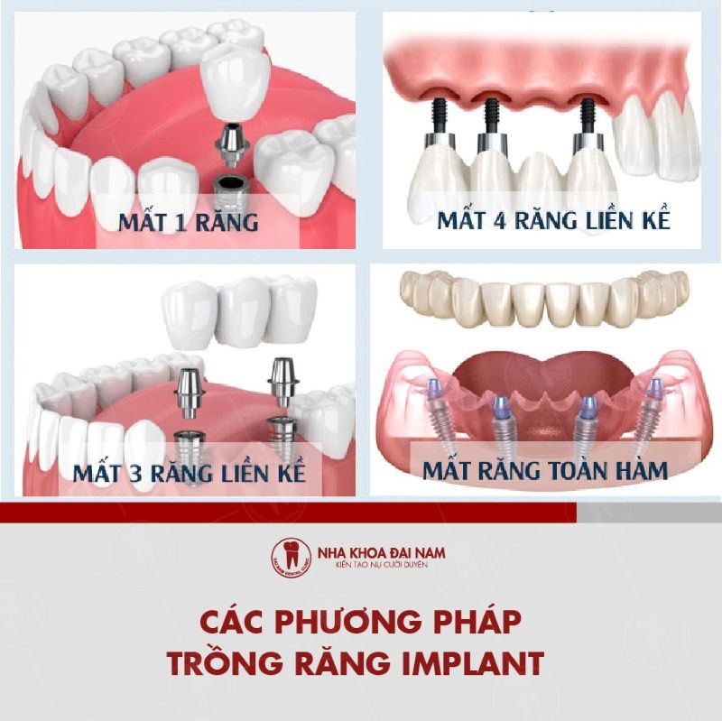 Cac phuong phap trong rang Implant duoc ap dung tai Nha khoa Dai Nam