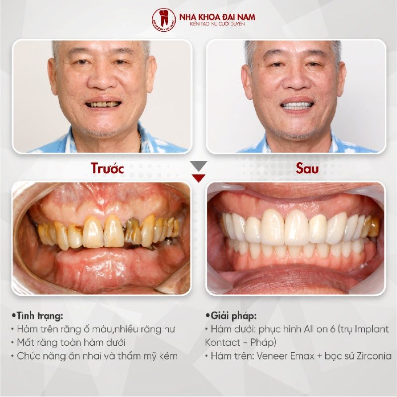 Khach hang trong rang Implant tai Nha khoa Dai Nam Binh Thanh