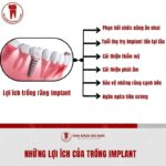 Trong Implant la phuong phap khac phuc tinh trang mat rang hieu qua va hien dai nhat