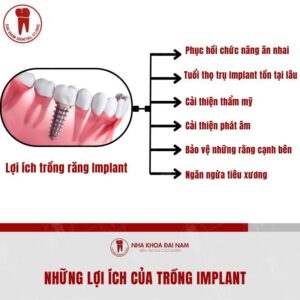 Trong Implant la phuong phap khac phuc tinh trang mat rang hieu qua va hien dai nhat