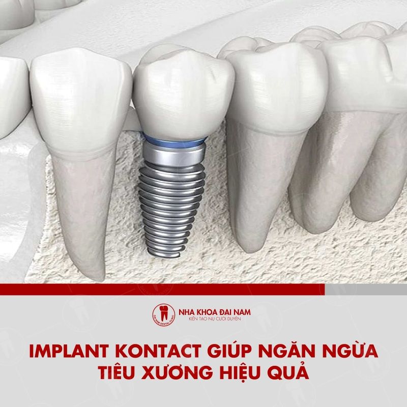 Implant Kontact giup ngan ngua tieu xuong hieu qua
