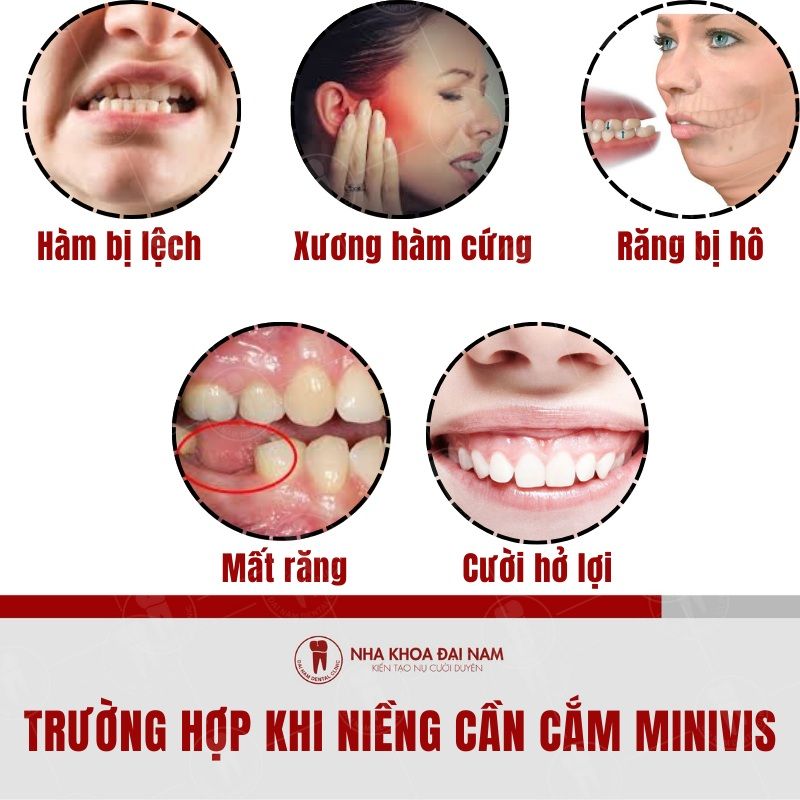 Mot so truong hop bac si se chi dinh cam vit khi nieng rang